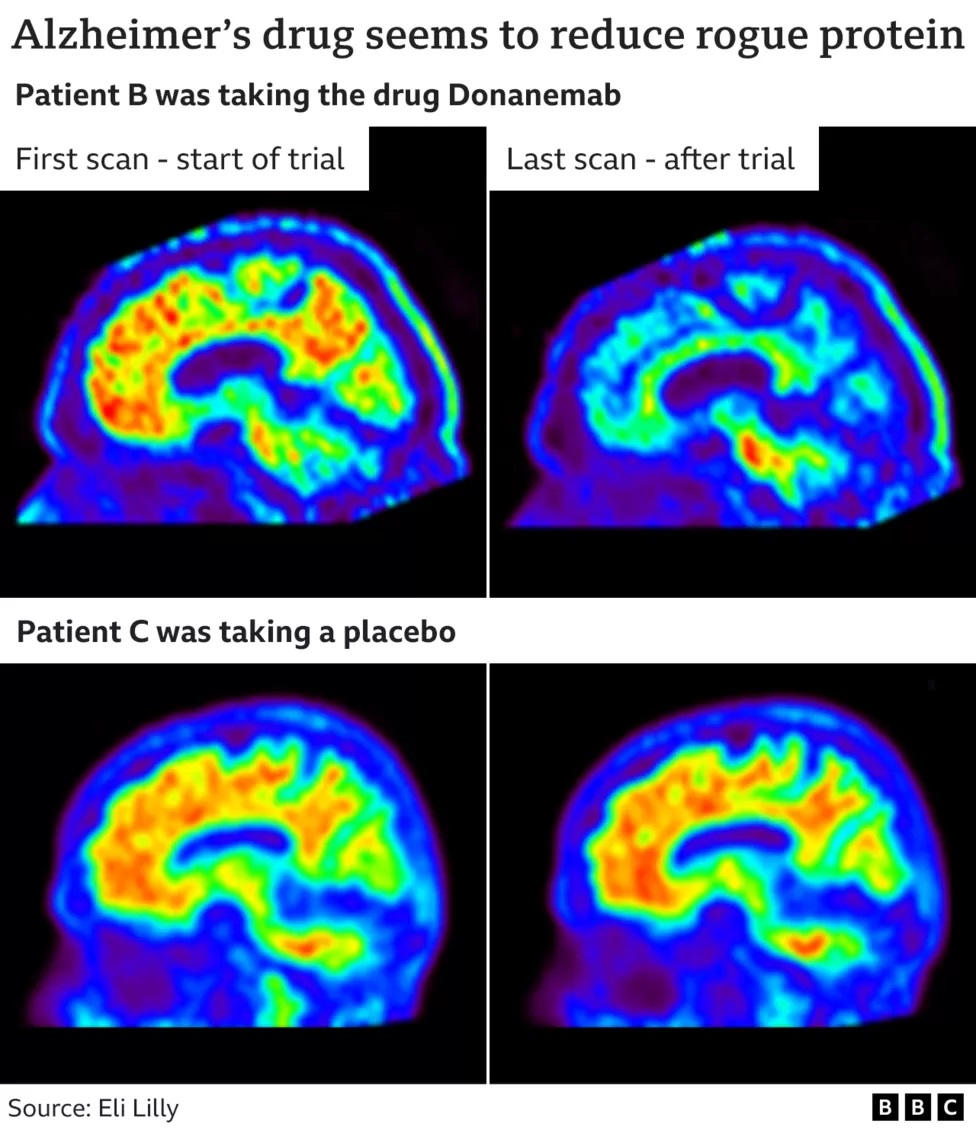 BBC Alzheimer's Drug