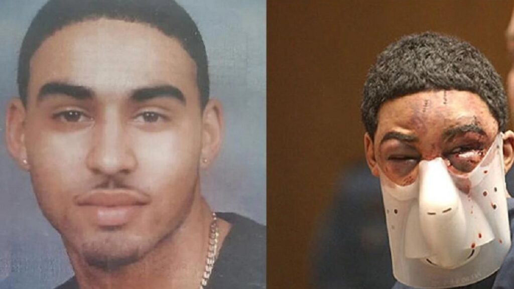 What Happened To Esteban Carpio Face? Reason Behind Face Mask Explored